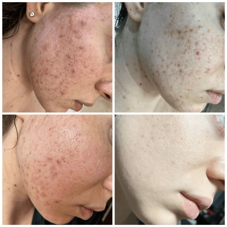 LoveLife Skin+ by med. Marci - Wsparcie cery trądzikowej od środka 250 ml